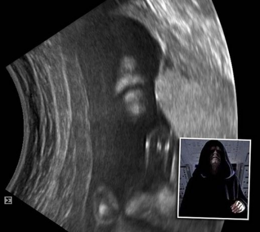 Palpatine aparece em ultrassom de bebê